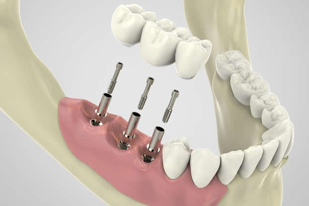 impianti dentali problemi dolore