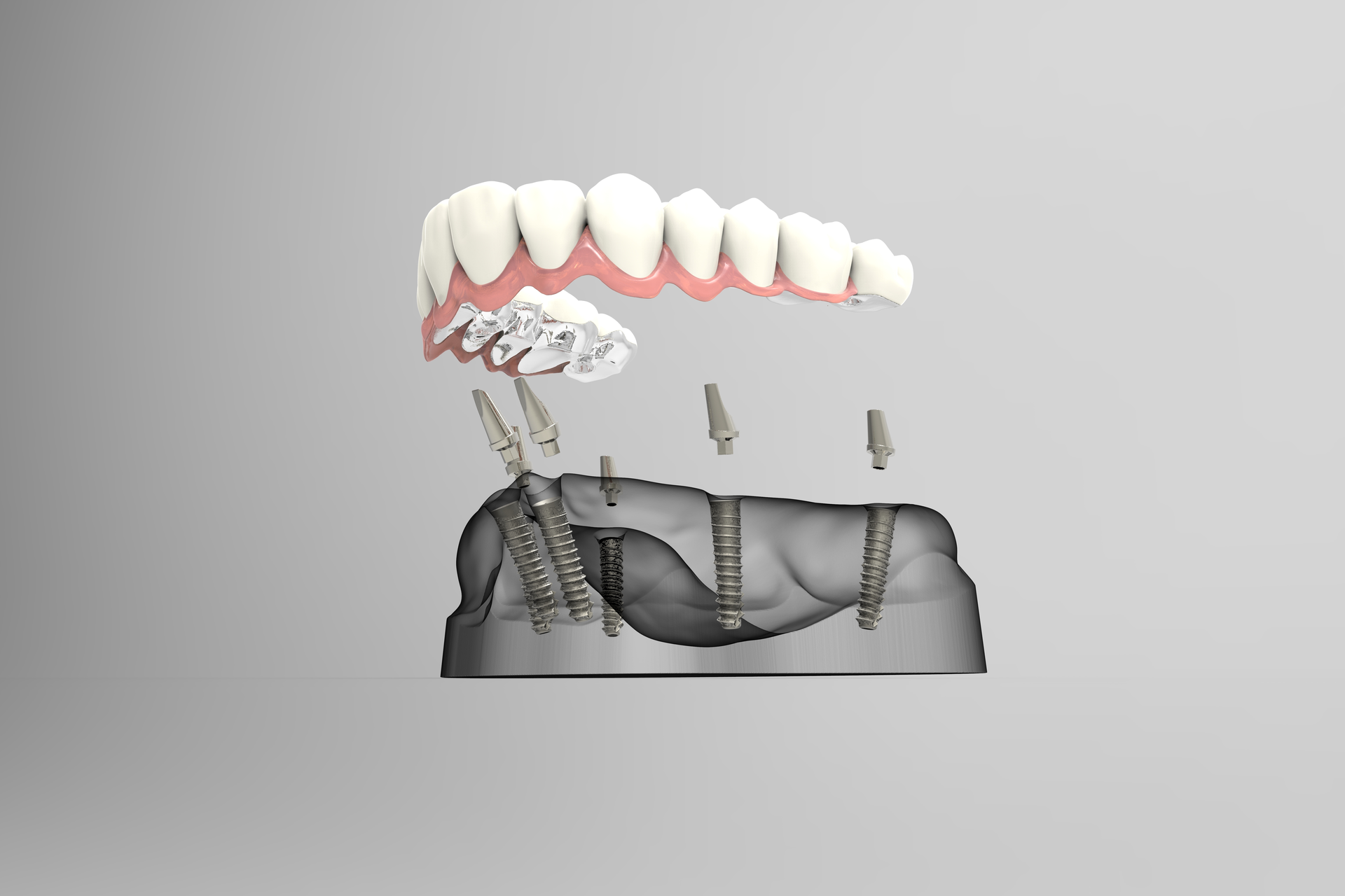 impianti dentali carico immediato